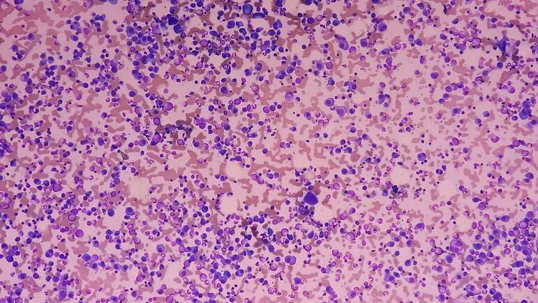 Le pomalidomide, agent immunomodulateur, est indiqué dans le traitement du myélome multiple.