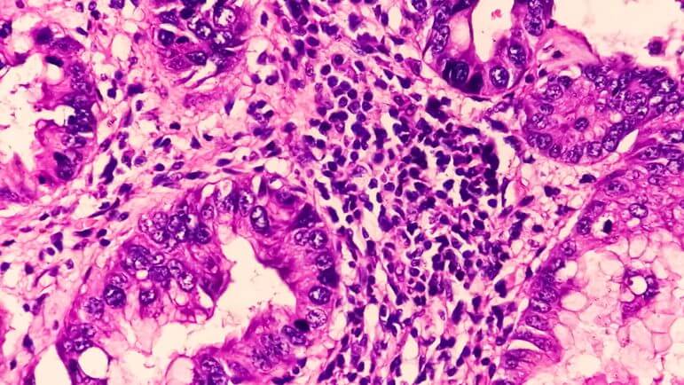 Indication dans certains cancers de la prostate métastatiques résistant à la castration.