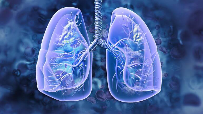 Cancer du poumon : ALECENSA, un traitement désormais recommandé ! L'alectinib est un inhibiteur de tyrosine kinase ciblant la mutation ALK.