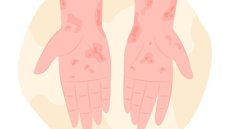 ECM : les lésions persistent plus de 3 mois et/ou récidivent au moins 2 fois par an.