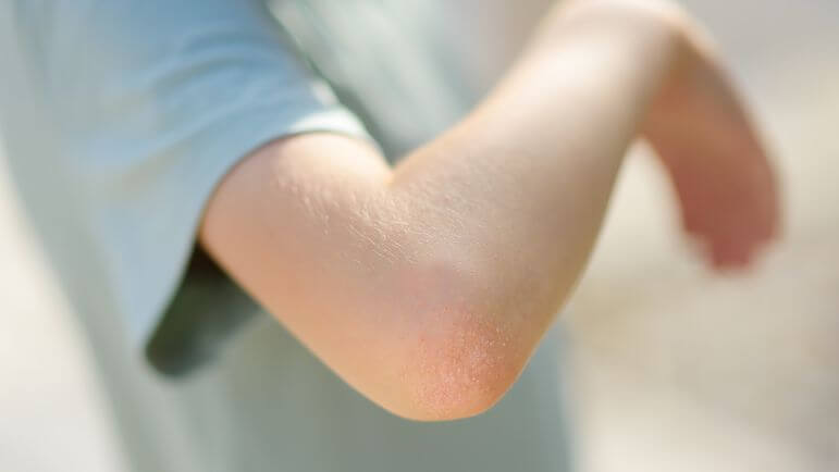 La prévalence du psoriasis en plaques de l’enfant est comprise entre 0,1 % à 1 an à 0,8 % à 18 ans.