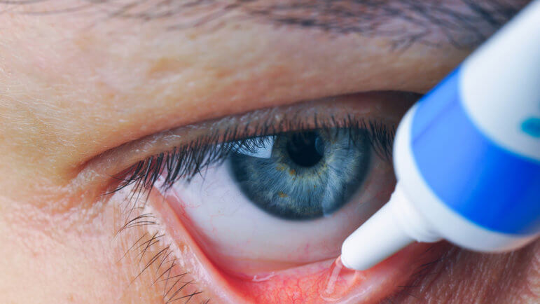 En cas de sécheresse importante de l'œil et de trouble de la cicatrisation de la cornée.