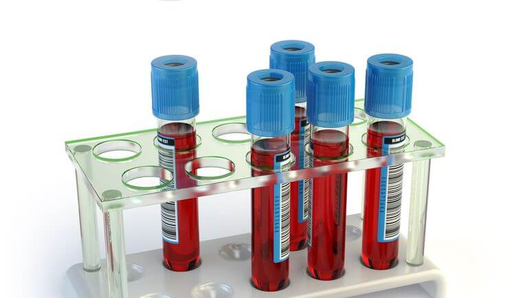 GHD : un test de stimulation de l’hormone de croissance est nécessaire pour confirmer le diagnostic.